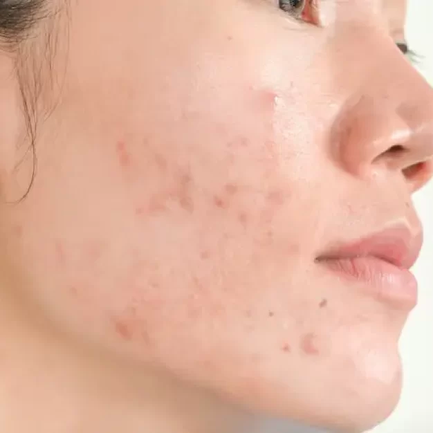Raraysae Acne Toner