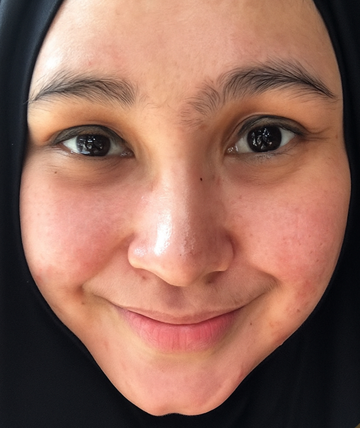 After Acne Treatment