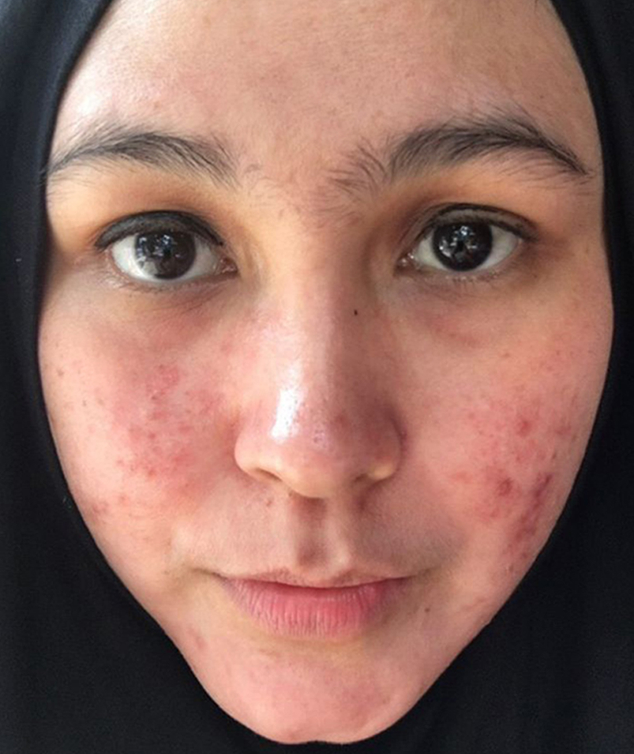 Before Acne Treatment