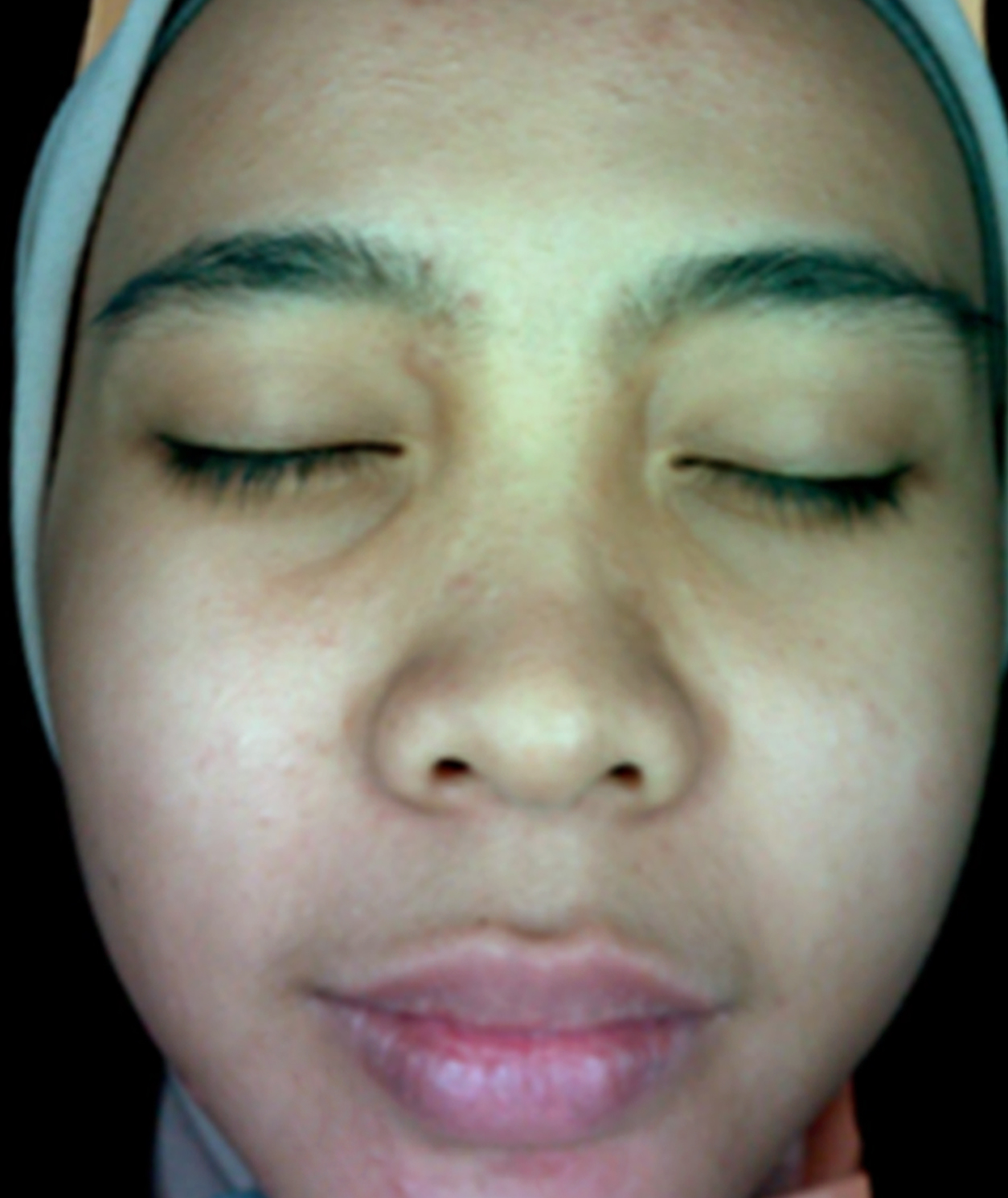 After Acne & Scar