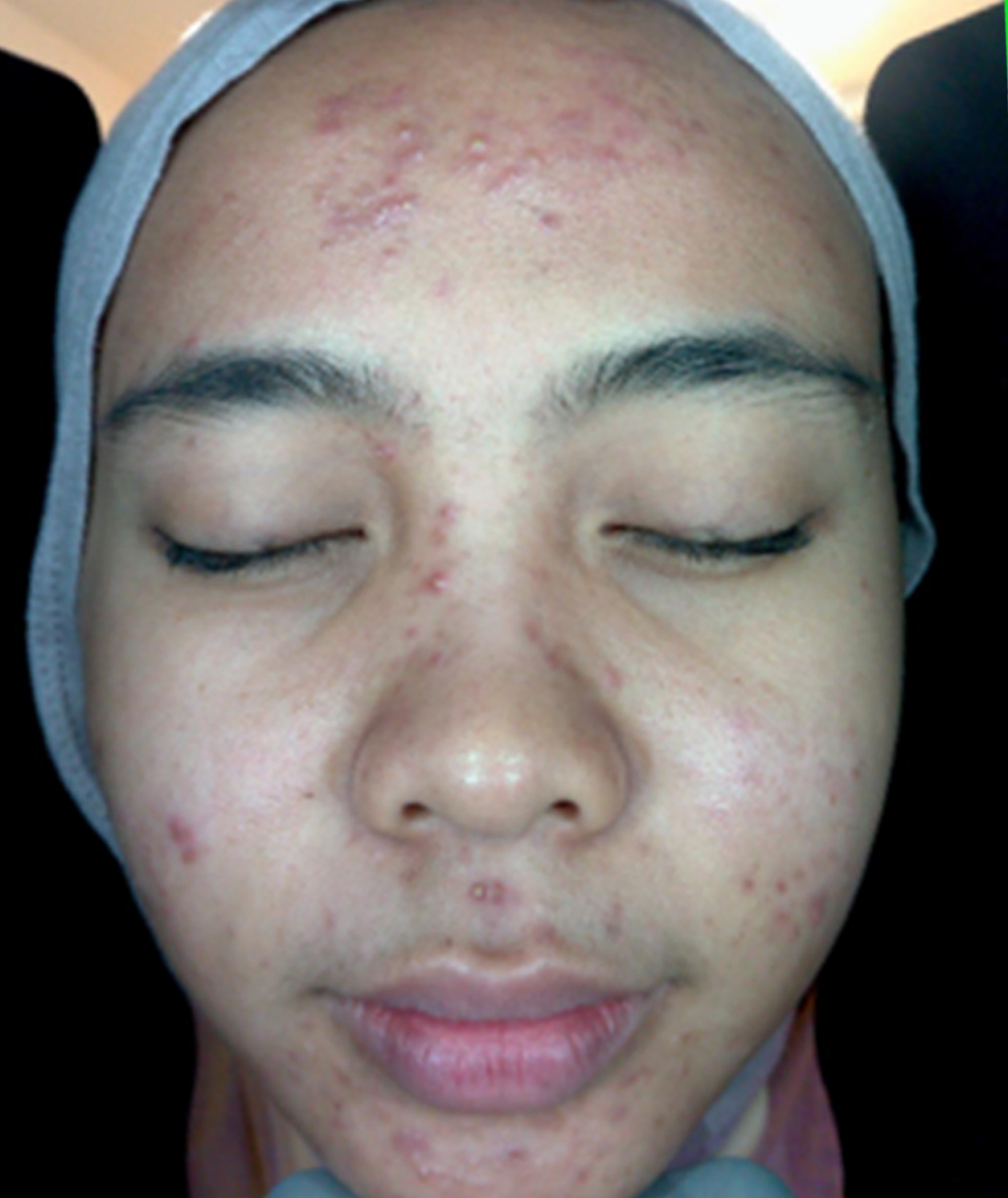 Before Acne & Scar