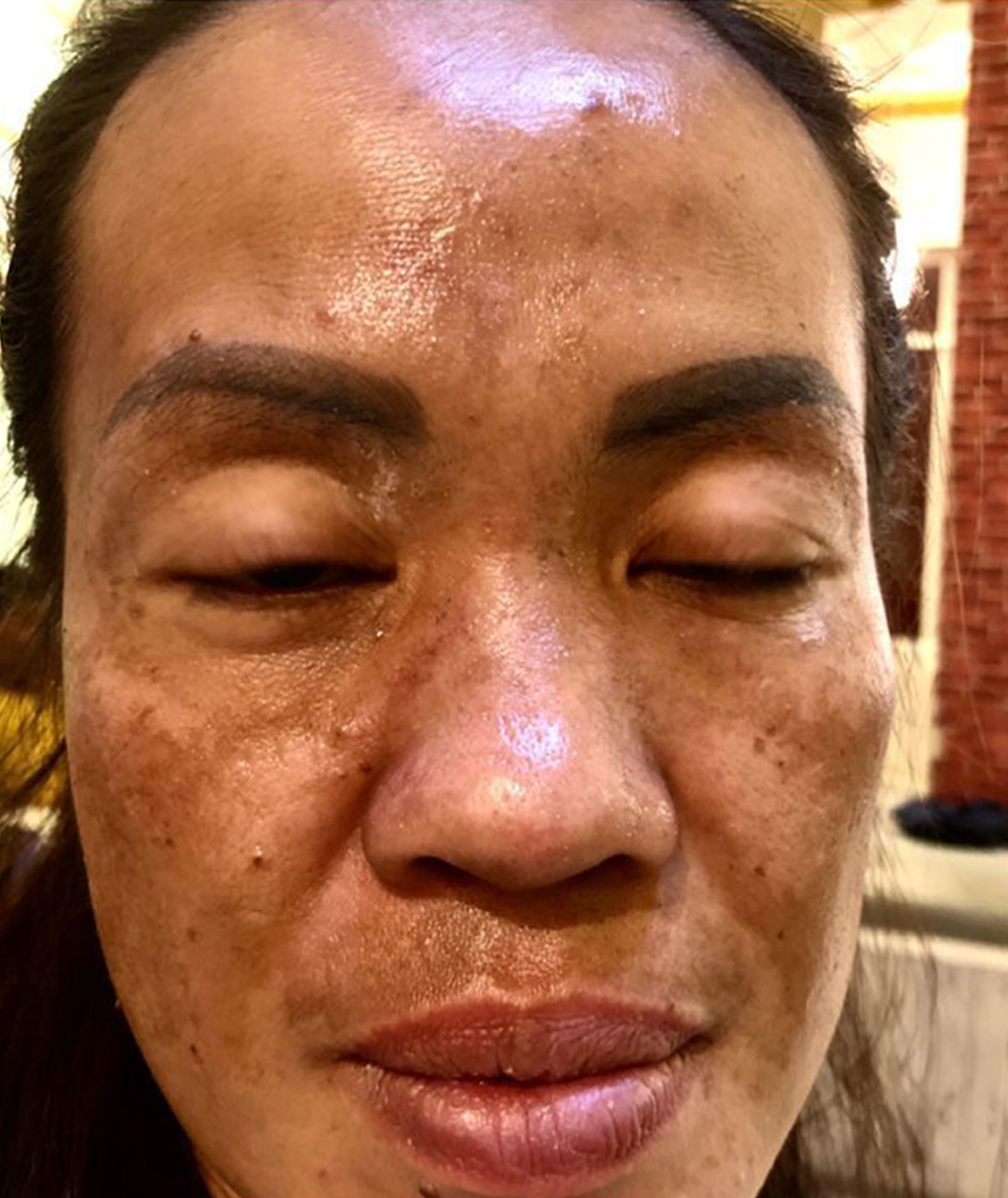 Before Flek & Dark Spot